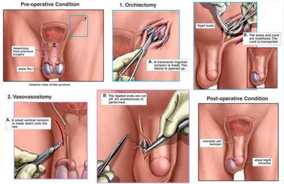 Orchiectomy Surgery Mega Porn Pics